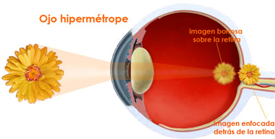hipermetropia optica