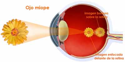 la miopía es una enfermedad cum să afli viziunea prin cec